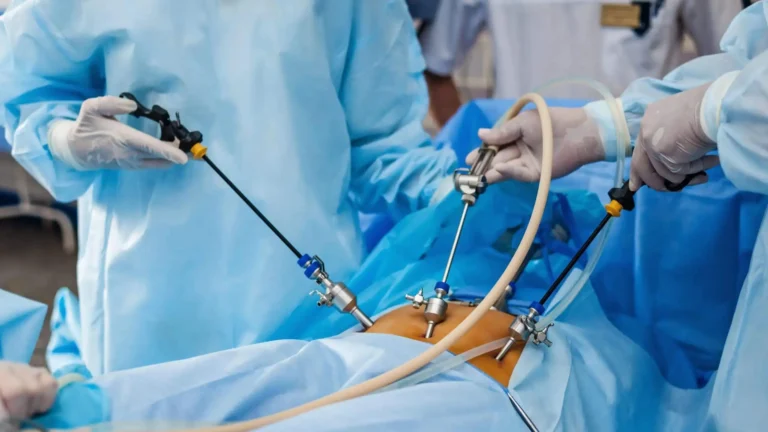 Surgeons performing a minimally invasive laparoscopic procedure, highlighting advanced surgical techniques used by female gynecologists for treating various gynecological conditions with precision and reduced recovery time.